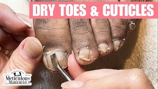 Discolored Dry Toenails Transformation [upl. by Spillar]