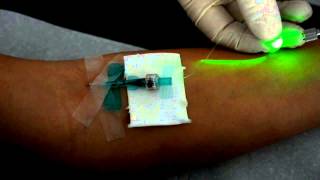 Intravenöse Laserblutbestrahlung mit dem Weberneedle® Endo Laser [upl. by Melanie348]