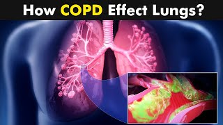 Chronic Obstructive Pulmonary Disease COPD  Symptoms Causes And Treatment UrduHindi [upl. by Ardnu]