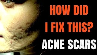 How to treat acne scars  Dermatologist explains [upl. by Uzzial]