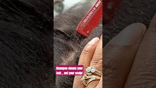 Do THIS before you shampoo to lift and remove psoriasis scalpscratching scalpcare [upl. by Neroc]