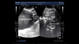 Understanding the different types of Ovarian Cysts [upl. by Pang33]