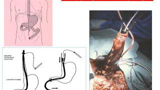 GASTROENTEROLOGIE CAT devant ingestion dun produit caustique [upl. by Karlen]