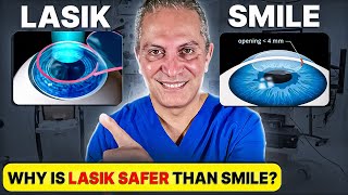 Should you Choose LASIK or SMILE Eye Surgery Eye Surgeon Explains [upl. by Sudoeht]