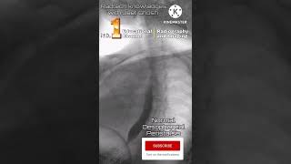 Barium swallow normal oesophagus constriction radiology xray mbbsstudent shorts [upl. by Llywellyn706]