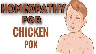 Chickenpox  Homeopathic Prevention amp Control  चिकेनपॉक्स को कैसे ठीकरोके [upl. by Lahpos]