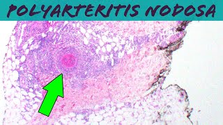 Polyarteritis Nodosa vasculitis pathology dermpath dermatology usmle dermatopathology [upl. by Hermon207]