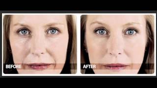 Phytoceramides Before And After [upl. by Wendell311]