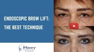 Endoscopic Brow Lift Video  Before amp After Brow Lift [upl. by Suolekcin]