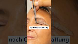 Oberlidstraffung LidKorrektur oberlid AntiAging Operation Ästhetik [upl. by Shotton]