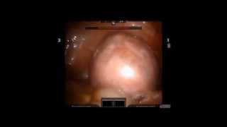 simple myomectomy using the robot [upl. by Aleahcim]