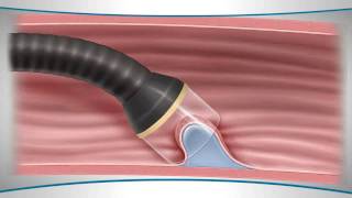 What is endoscopic mucosal resection [upl. by Synn]