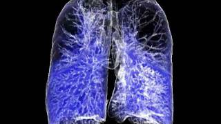 iradka Lung Emphysema COPD CT 3D [upl. by Lonnard]