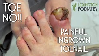 TOE NO Painful Ingrown Toenail Removal [upl. by Breed719]