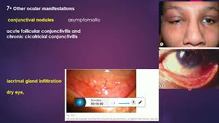 sarcoidosis and uveitis [upl. by Soalokin]