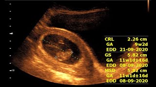 Inside 9 Weeks Pregnancy  Fetal Development and Ultrasound Insights [upl. by Bruno]