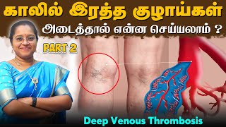 🩸 காலில் இரத்த குழாய்கள் அடைத்தால் என்ன செய்யலாம்  Deep Venous Thrombosis  Part  2  Dr AVENI [upl. by Huckaby]