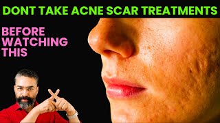 Dont Take Acne Scar Treatments Before Watching This  Best Acne Scar Treatment acnescars [upl. by Aridaj]