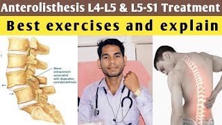 anterolisthesis l5 s1 treatment anterolisthesis grade 1 treatment exercises l4 l5 lumbar spine [upl. by Secor]