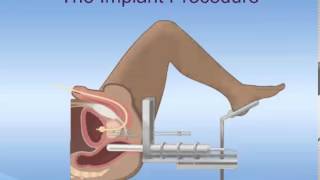 Brachytherapy for Prostate Cancer [upl. by Elaweda]