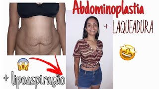 FIZ ABDOMINOPLASTIA LIPOASPIRAÇÃO E LAQUEADURA Abdominoplastia pelo convênio [upl. by Annahpos]