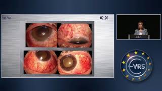 Argus II Epiretinal Prosthesis System Implantation in Endstage Retinitis Pigmentosa [upl. by Averell]