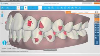 Invisalign ClinCheck Pro Tutorial planificación attachments  Ortodoncia Friedländer Barcelona [upl. by Alten]