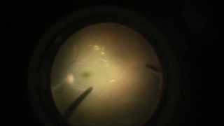 Vitrectomy in the treatment of ocular toxoplasmosis german [upl. by Saturday]