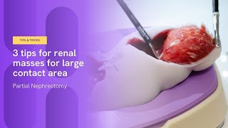 3 tips for renal masses with large contact area  Partial Nephrectomy [upl. by Siuqcram]