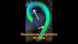 Imagen impresionante de disección aórtica men 4D FLOWmedicina radiología cardiologia mri salud [upl. by Aible602]