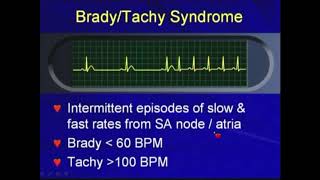 51c BradyTachy Syndrome  Bradyarrhythmias Hong Kong University [upl. by Aissenav]