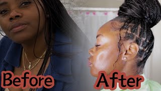 How I cleared my hyperpigmentation in a month very detailed [upl. by Amisoc]