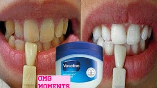 Turn dirty yellow teeth to White in just 3 minutes [upl. by Einaeg282]