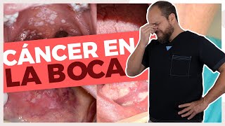 CANCER en la BOCA 😔 ¿Por qué DA  ¿Cómo RECONOCERLO 🚨 [upl. by Pelag45]