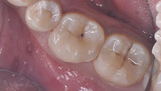 Direct composite restoration with selective caries removal [upl. by Wilona]