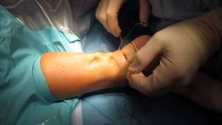 Percutaneous Achilles Tendon Surgery Repair Unedited by Kevin R Stone MD [upl. by Ellyn]