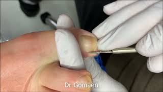 내성발톱제거 asmr 스마일밤 ingrown toenail removal asmr smile bam part 335 [upl. by Pallaten]