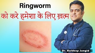 Ringworm Treatment दाद  Fungal Infection Infection Best Treatment  Best Homeopathic Doctor [upl. by Sitnerp]