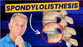 Spondylolisthesis 4 Exercises to Reduce Pain Demo on Real Patient [upl. by Akinod]