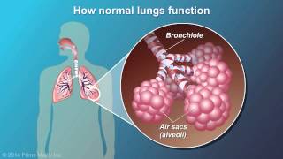 Understanding COPD [upl. by Asil]