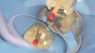 Molar endo highlights [upl. by Seedman102]