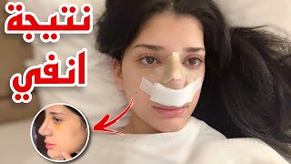 اخيرا نتيجة انفي بعد عملية التجميل 👃🏻 [upl. by Urina]