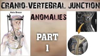 CRANIOVERTEBRAL JUNCTION ANOMALIES  PART1  SOFT TISSUE ANOMALIES  BONY ANOMALIES [upl. by Bander305]