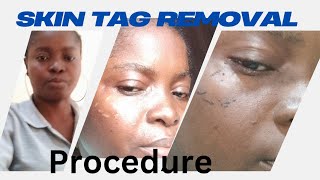 Skin tag removal procedure [upl. by Boice837]