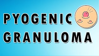 Pyogenic Granuloma Symptoms Treatment and Causes [upl. by Cleo]