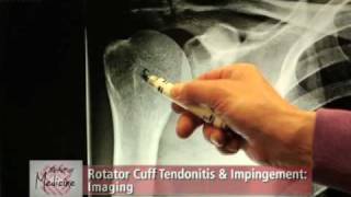 Rotator Cuff Impingement amp Tendonitis Part 2 Symptoms amp Evaluation [upl. by Ozzie]