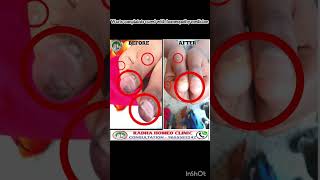 wart treatment in tamil  warts removal in tamil  maru poga tips in tamil  dr balajimuthu [upl. by Lirrad118]