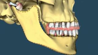 Avance mandibular  Ortodoncia [upl. by Oehsen235]