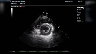 Echocardiographic presentation of loose chordae tendineae versus tertiary chordae rupture [upl. by Carena917]