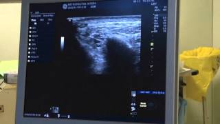 TRIGEMINAL NERVE BLOCK ultrasound guided [upl. by Eniamraj216]